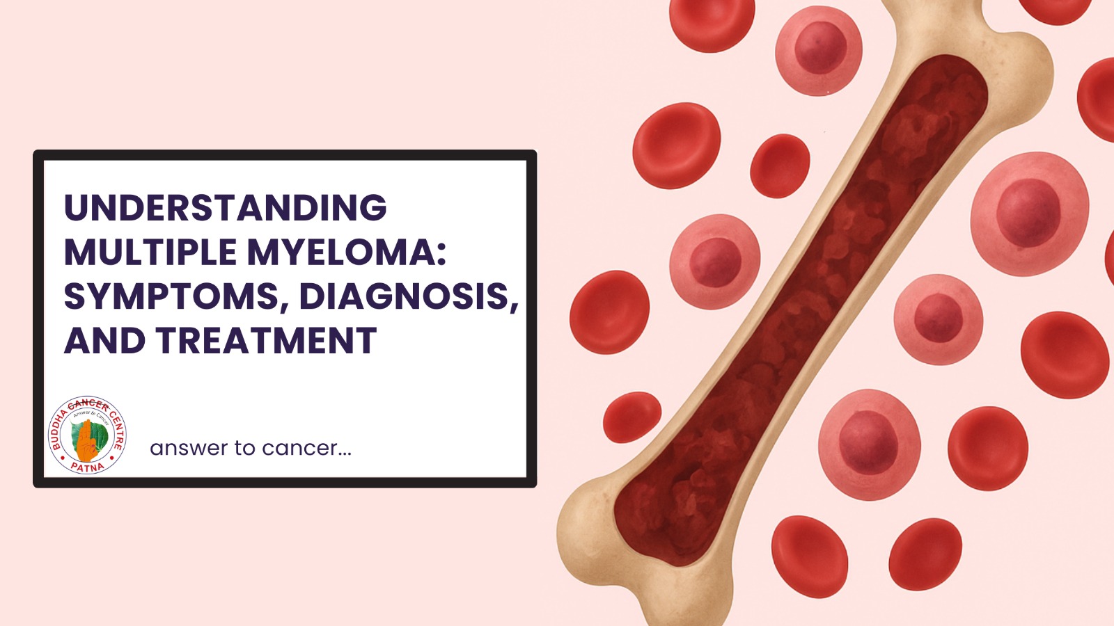 Understanding Multiple Myeloma: Symptoms, Diagnosis, and Treatment