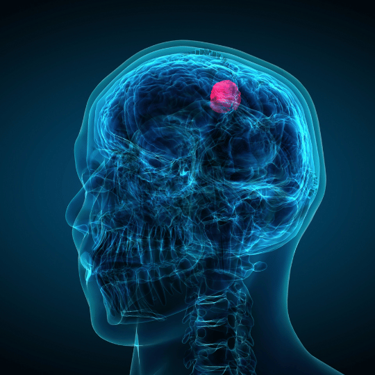 Brain tumor
